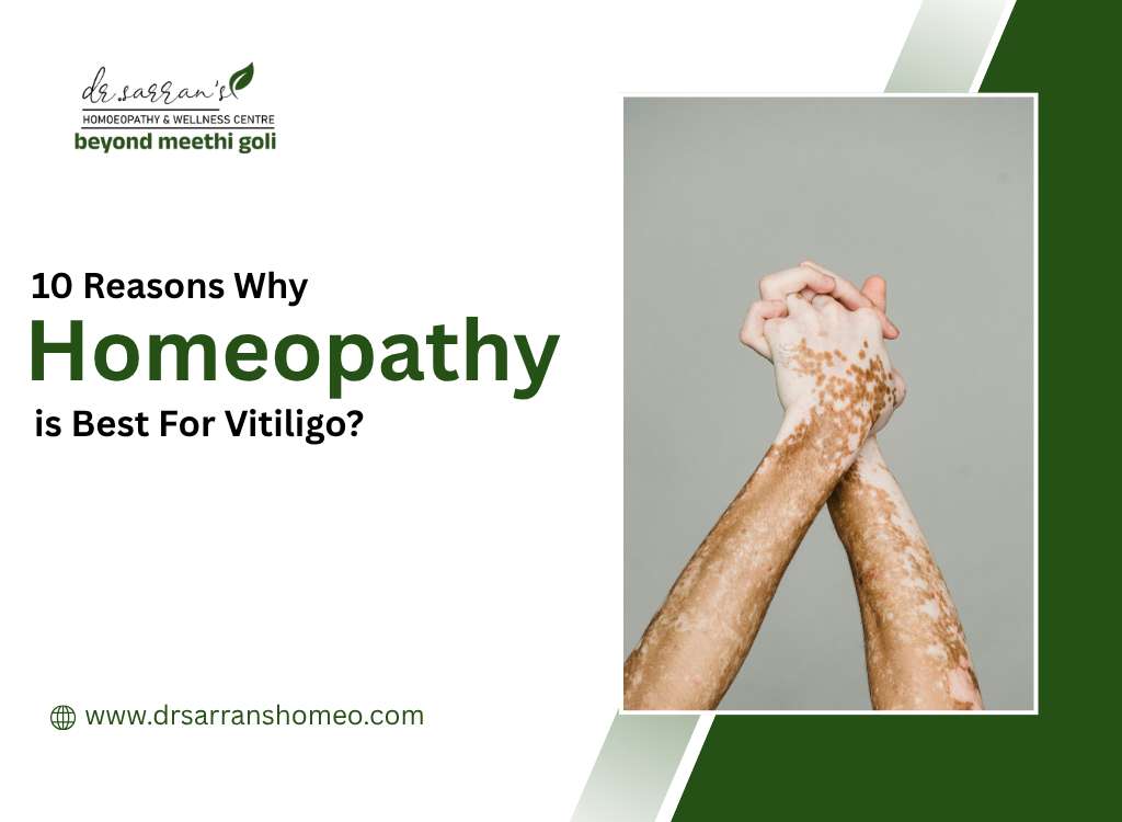 Homeopathy is Best For Vitiligo