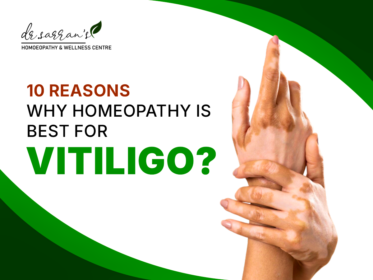 homeopathy-is-best-for-vitiligo-malad-west-mumbai