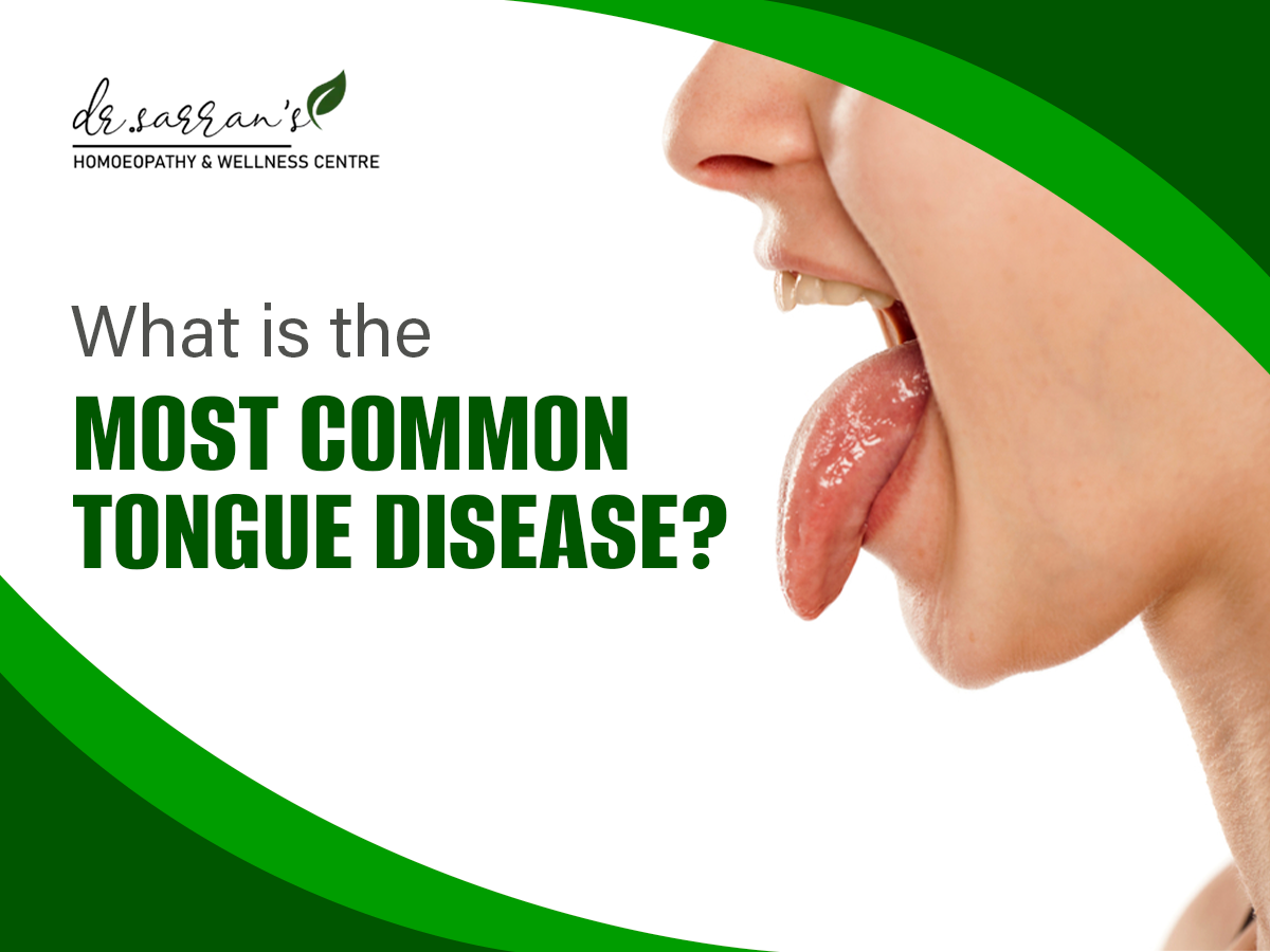 most common tongue disease