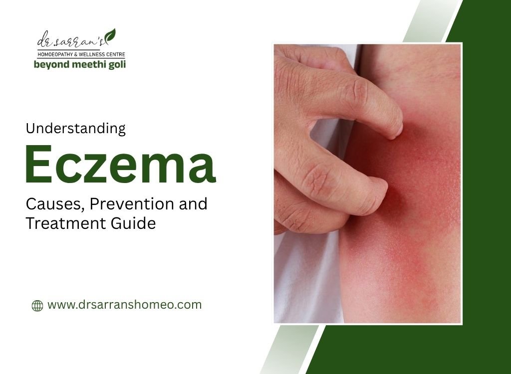 Eczema causes, prevention tips, and homeopathic treatment options illustrated for better skin health