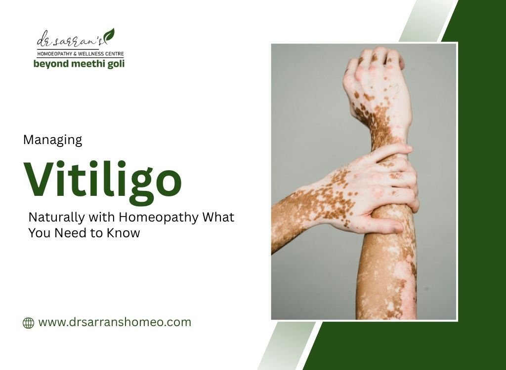 Person with vitiligo patches on the skin, highlighting natural homeopathic care and holistic skin health support.
