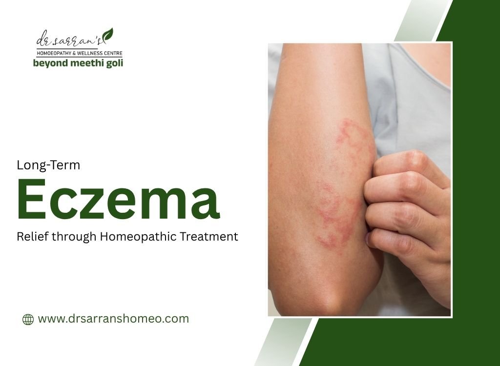 Person applying soothing care to dry and irritated skin affected by eczema, highlighting natural homeopathic eczema treatment.
