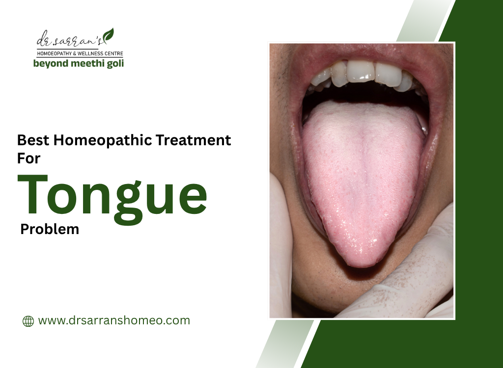 Best Homeopathic Treatment For Tongue Problem