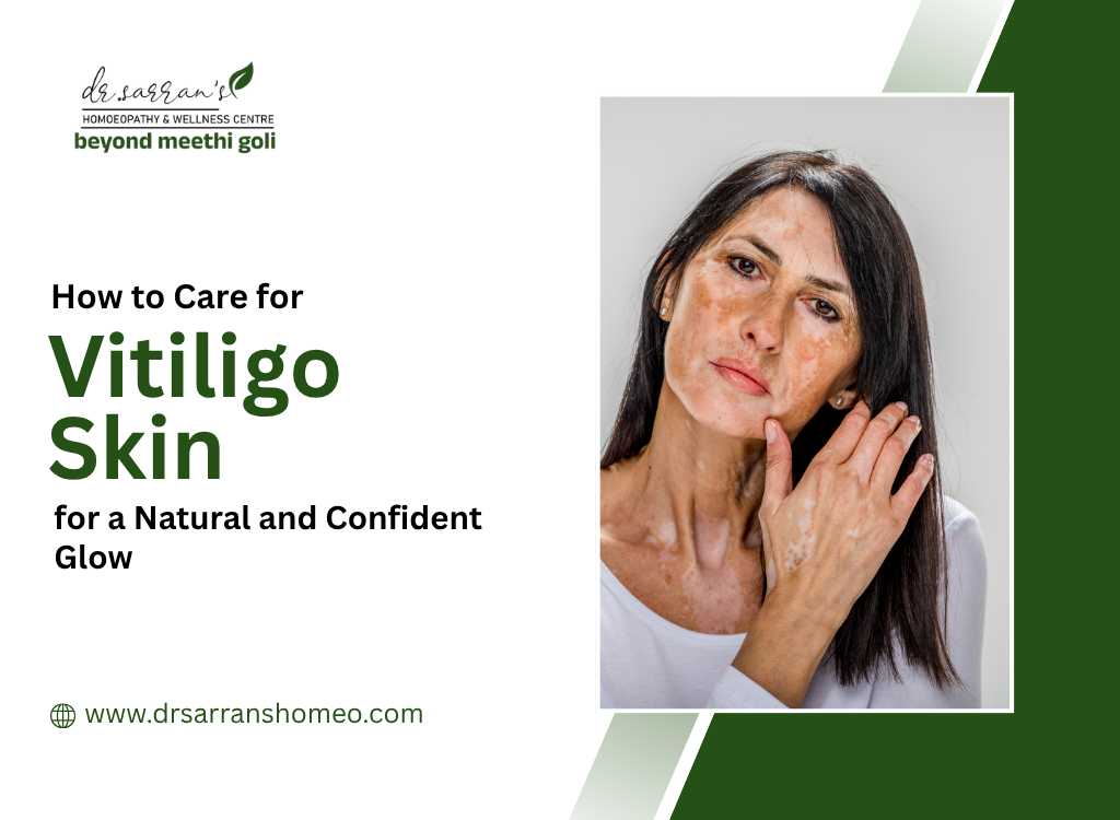 Vitiligo Skin for a Natural and Confident Glow