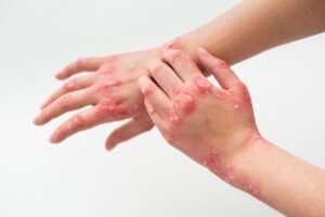 Homeopathic treatment for eczema