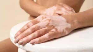 Homeopathic treatment for vitiligo