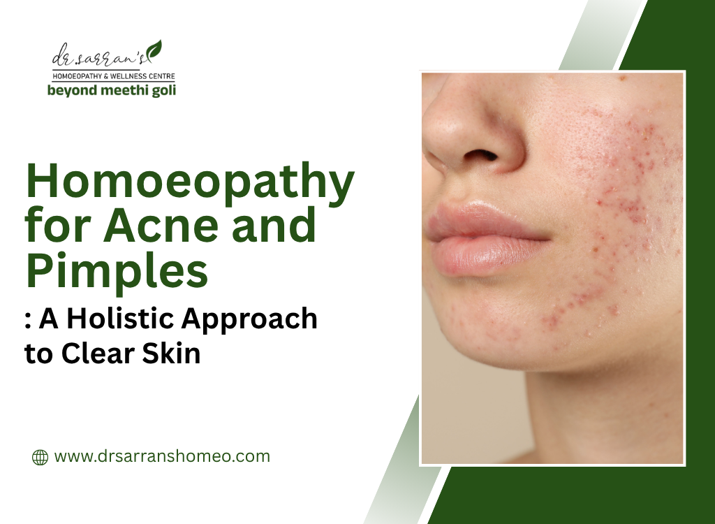 Homoeopathy for Acne and Pimples
